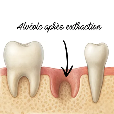 Schéma de l’alvéole après l’extraction dentaire