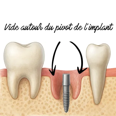 Schéma expliquant pourquoi l’implant seul ne suffit pas après l’extraction