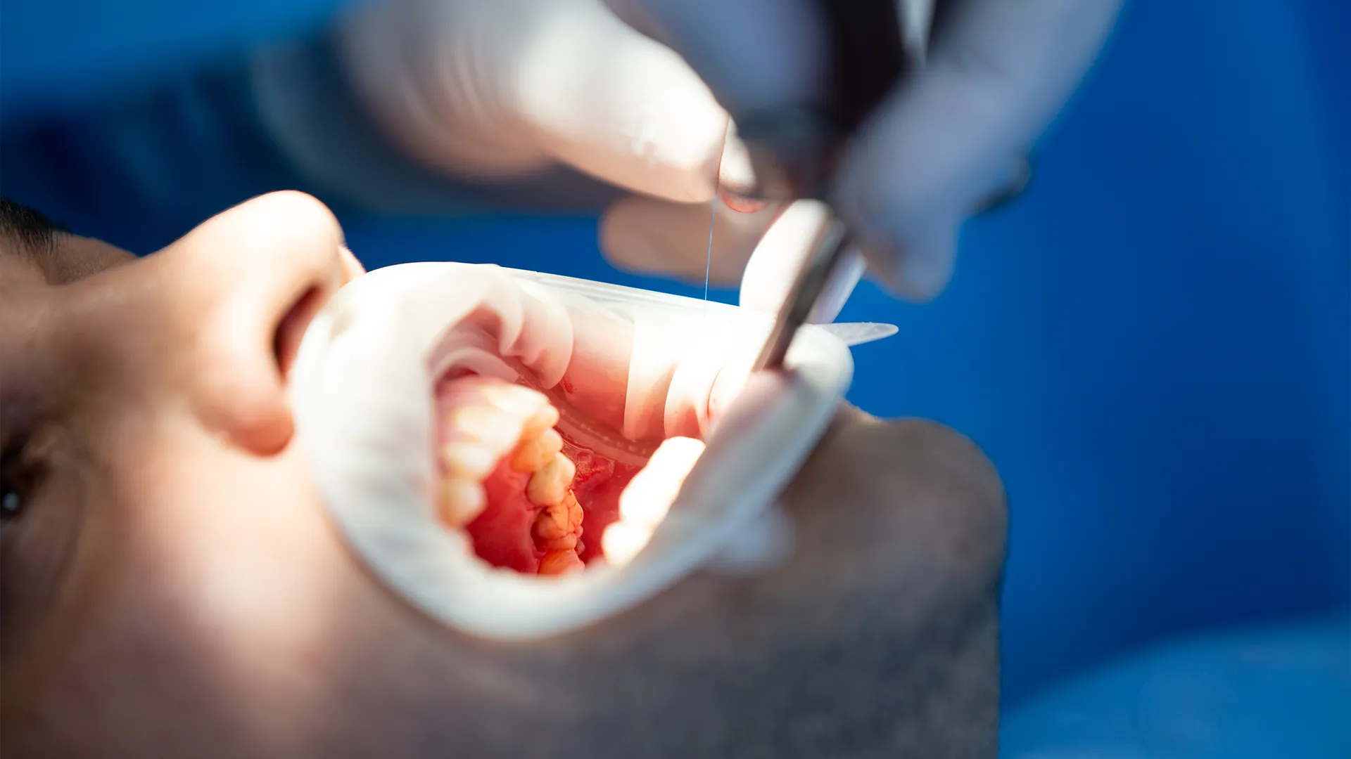 Extraction et implantation dentaire immédiate assistées au laser à la Clinique Les 8 à Hognoul près de Liège